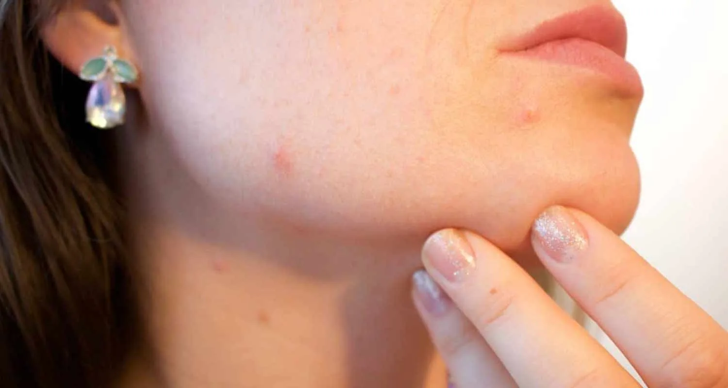 Tutti i rimedi per il trattamento de acne